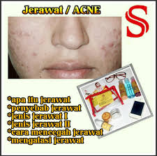 Jenis jerawat yang muncul ada berbagai macam, dan salah satunya adalah cystic acne atau jerawat batu. Dee S Shineskin Solo Posts Facebook