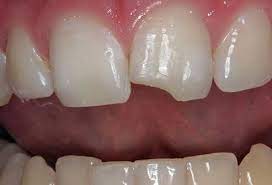 We did not find results for: Teeth Grinding Treatment Mouth Guards And How To Stop