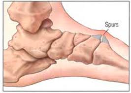 A bone spur is a small bony growth or collection of bony growths on or near the joints. Bone Spur Katia Mis S Blog