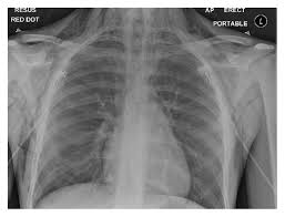 Blank for personal message illustration: Pneumomediastinum Secondary To Barotrauma After Recreational Nitrous Oxide Inhalation Abstract Europe Pmc