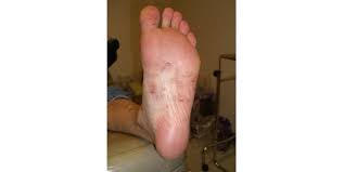 Image result for brown patches on the feet