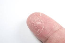 Nutzen sie ihr waschmittel, um sekundenkleber von den. Superkleber Von Haut Entfernen 3 Bewahrte Hausmittel