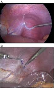 First Reported Experience With Intramuscular Diaphragm Pacing In Replacing Positive Pressure Mechanical Ventilators In Children Journal Of Pediatric Surgery