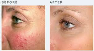 Pin By Tanya C P On Rosacea Sensitive Skin Laser Skin Rejuvenation Rosacea Treatment Intense Pulsed Light