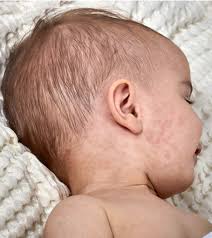 Has a fever of 102 degrees f or higher for 24 hours. Viral Rashes In Babies Types Pictures Diagnosis Treatment