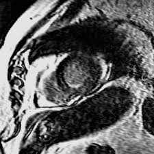 The mri myocarditis protocol encompasses a set of different mri sequences for the cardiac assessment in case of suspected myocardial inflammation. Differentiating Acute Myocardial Infarction From Myocarditis Diagnostic Value Of Early And Delayed Perfusion Cardiac Mr Imaging Radiology