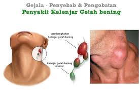 Penyebab kanker getah bening masih belum diketahui dengan pasti, namun ada beberapa faktor risiko yang dapat menyebabkan seseorang. Penjelasan Penyakit Kelenjar Getah Bening Gejala Serta Pengobatannya