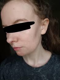 Liệu pháp Zero hiệu quả NHƯNG bạn cần phải cam kết với nó