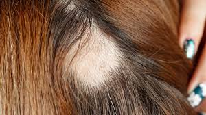 Topical photochemotherapy for alopecia areata. Diagnose Alopecia Areata Wie Entsteht Kreisrunder Haarausfall Und Welche Therapie Hilft News De