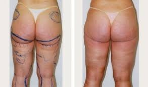 The medical center is located in istanbul, turkey. Brazilian Butt Lift Nyc Fat Transfer Buttocks Nyc