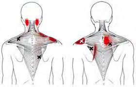 Trapezius Trigger Point Map Trigger Point Therapy Trigger Points Muscle Knots