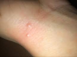 Image result for spinne biss haut reaktion