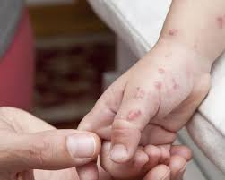 Image result for shingles in children