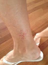 Golfer S Vasculitis Or Ankle Heat Rash What Causes Ankle Heat Rash Heat Rash Lower Leg Rash Leg Rash