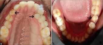 genetics and presence of non syndromic supernumerary teeth