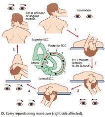 Benign Paroxysmal Positional Vertigo Bppv Oliver Adunka