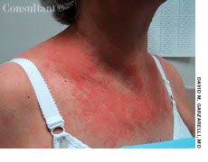 Skin rashes are uncommon symptoms of hodgkin lymphoma. Cutaneous T Cell Lymphoma In A Woman With Pruritic Erythematous Rash Patient Care Online