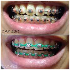 Harga pasang braces kat situ ialah rm 4.9k all in. Fatimahnabila March 2018