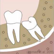 Lower wisdom teeth that are painful, have pathology such as cysts, or are causing damage to adjacent teeth may require removal. Coronectomy British Association Of Oral And Maxillofacial Surgeons