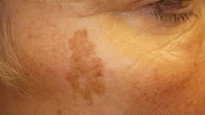 Blocks rosacea triggers & promotes healthy cell growth. Sunspots On Skin Causes And Treatment