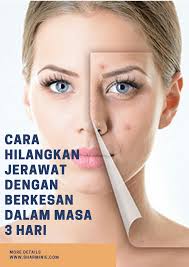 Dalam artikel ini terdapat beberapa cara untuk menghilangkan penyakit kulit ini dari wajahmu. Cara Hilangkan Jerawat Dunia Belajar