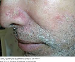 Image result for Beard Dermatitis