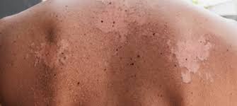 Image result for Radiation Dermatitis