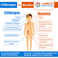 Image result for measles