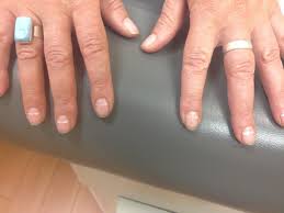 Image result for Muehrcke Line