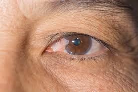 Image result for Glaucoma
