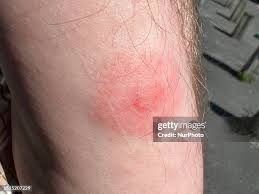 Image result for infected tick bite