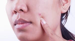 The beginning signs of skin cancer involve a change in the skin. Can Skin Cancer Look Like A Pimple
