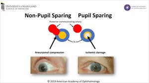 Image result for Pupillary Paralysis