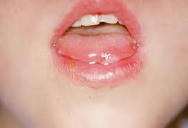 Image result for Hand foot and mouth disease HFMD roof of mouth