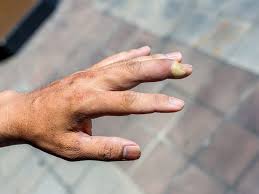 Image result for paronychium