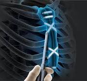 Arthrex - Sistema de fechamento esternal FiberTape®