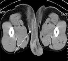 Joint trust clinical procedure for managing fournier's gangrene v1.1; Early Signs Of Fournier Gangrene Radiological Characteristics