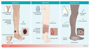 Image result for Perthes Test