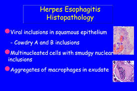 Very few cases of a multiple viral infection have been reported. Infectious Esophagitis Immunocompromised Host Steroids Chemo Rad Therapy Aids Transplant Patients Endoscopic Appearance Location Often More Proximal Ppt Download