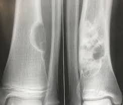 Osteochondroma, or osteocartilaginous exostosis, is the most common skeletal neoplasm. Bone Tumors Gilbert Az Foot Doctor
