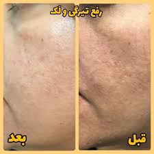 nazbeauty777 | ‎قبل و بعدهای روشن کننده گاتیو🌿 @nazbeauty777 سلام دوستای  عزیزم ❤ یکی از مشکلات رایج پوستی در بین خانمها و آقایان تیرگی نواحی مختلف  بدنه...‎ | Instagram