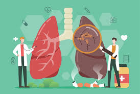 Lung cancer may not produce symptoms that are noticeable in the early stages. 14 Silent Signs Of Lung Cancer That May Surprise You Health Jockey