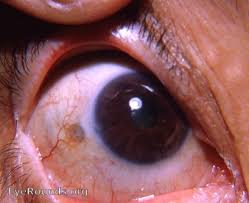 Image result for lesion sclera
