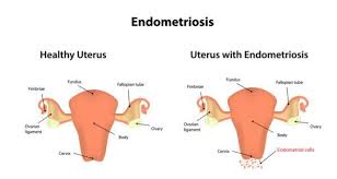 Endometriosis is a full body condition in which cells similar to those in the endometrium, the layer of tissue that normally covers the inside of the uterus, grow outside the uterus. Endometriosis Health Tips Endometriosis Health Articles Health News Thehealthsite Com
