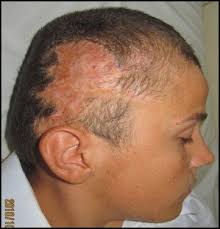 As if the hairloss wasn't enough, a sore, sometimes burning, irritated scalp enters the picture. A Postburn Alopecia B Crescent Expander Under The Normal Scalp Download Scientific Diagram