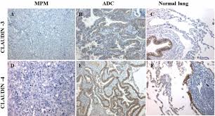 Mesothelioma is a type of cancer that develops from the thin layer of tissue that covers many of the internal organs (known as the mesothelium). M14k And M38k Malignant Pleural Mesothelioma Cell Lines Preserve The Same Claudin Based Phenotype In Vivo In Vivo
