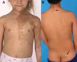 Image result for Precocious Puberty