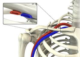 Thoracic Outlet Syndrome Treatment Sydney Tos Treatment Sydney
