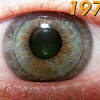 Trial lenses are available while supplies last. 1
