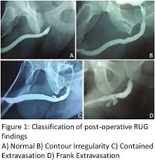 Image result for Retrograde Urethrogram